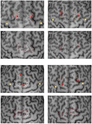 Mapping of the supplementary motor area using repetitive navigated transcranial magnetic stimulation